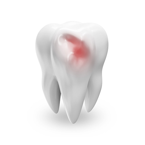 root canals in Temple City treat tooth pain