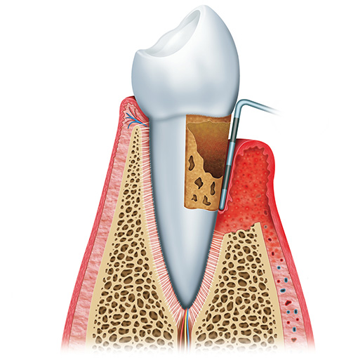 gum disease is dangerous