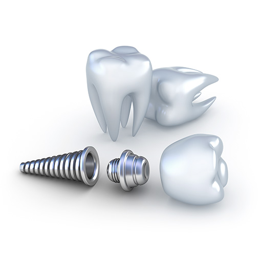 Temple City dental implants