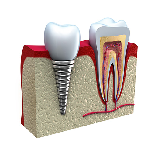 dental implants work like magic