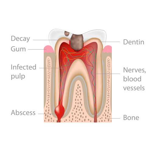 root canal indications Temple City