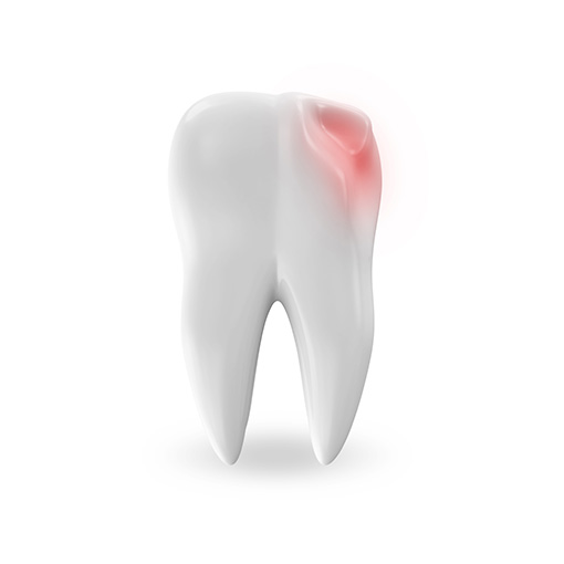 tooth decay pain relief in Temple City 