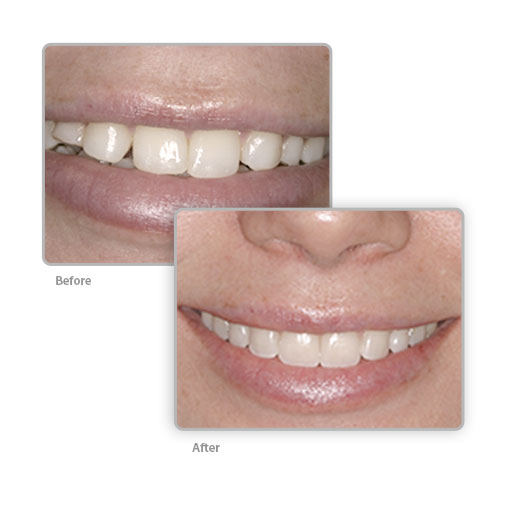 porcelain veneers Temple City before and after